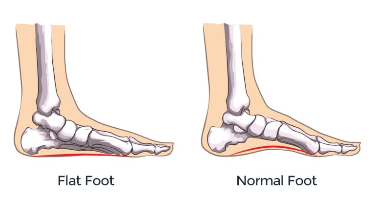 flat feet and normal feet