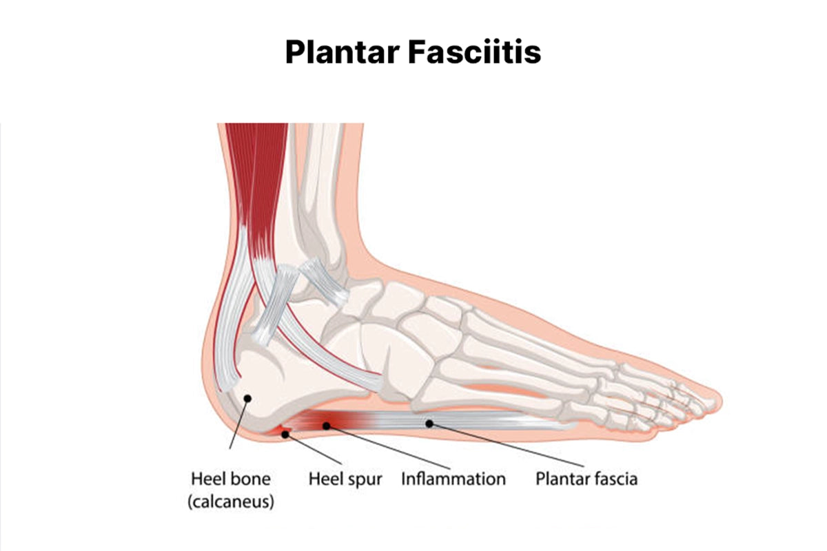1doctor recommended shoes plantar fasciitis