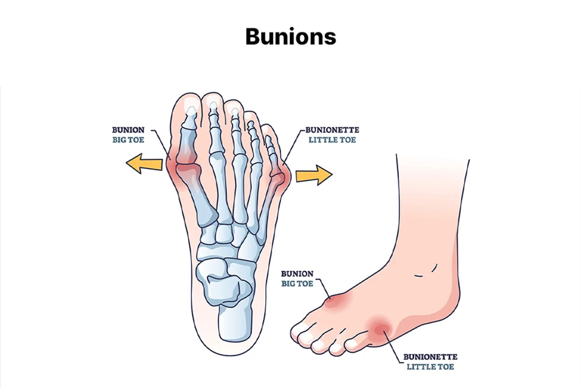 Comfortable men’s walking shoes for bunion pain